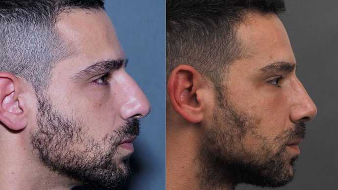 revision rhinoplasty before after dr mireas