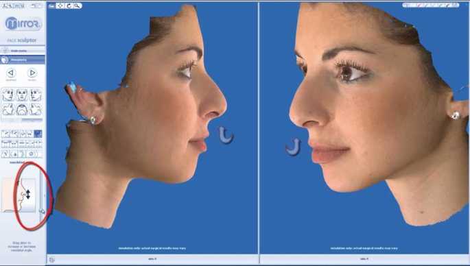 Vectra M3 3D rhinoplasty simulation system developed by Canfield Scientific. Dr.Mireas. Changing tip high
