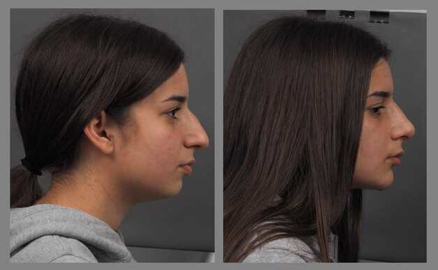 rhinoplasty chin augmentation before and after photo best surgeon rinoplastiki com (2)