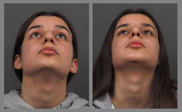 rhinoplasty chin augmentation before and after photo best surgeon rinoplastiki com (5)