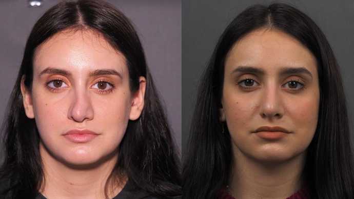 revision rhinoplasty 3 months after