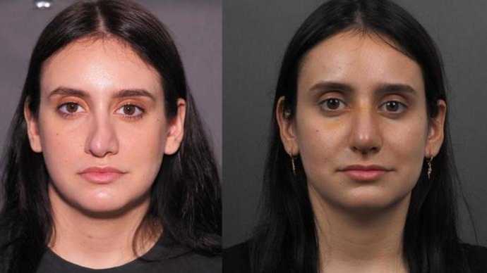 Before and after photos. Secondary rhinoplasty 6 days post-op 