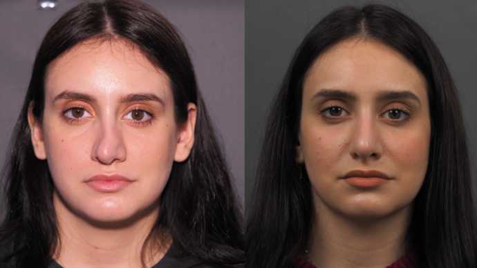 Before and after photos. Secondary rhinoplasty 6 montsh post-op