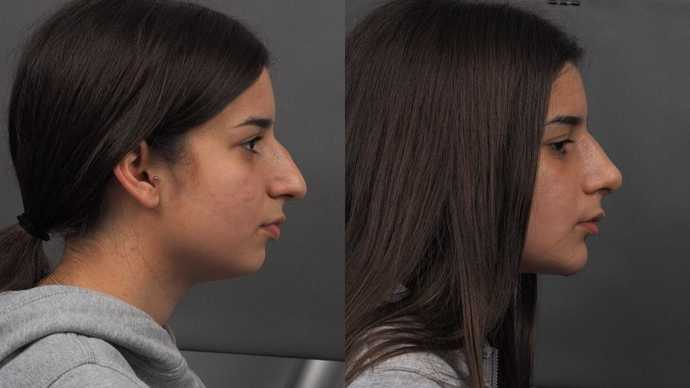 ULTRASONIC RHINOPLASTY BEFORE AND AFTER DR MIREAS ATHENS GREECE (211)