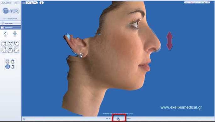 Vectra M3 3D rhinoplasty simulation system developed by Canfield Scientific. Dr.Mireas. Altering the tip rotation